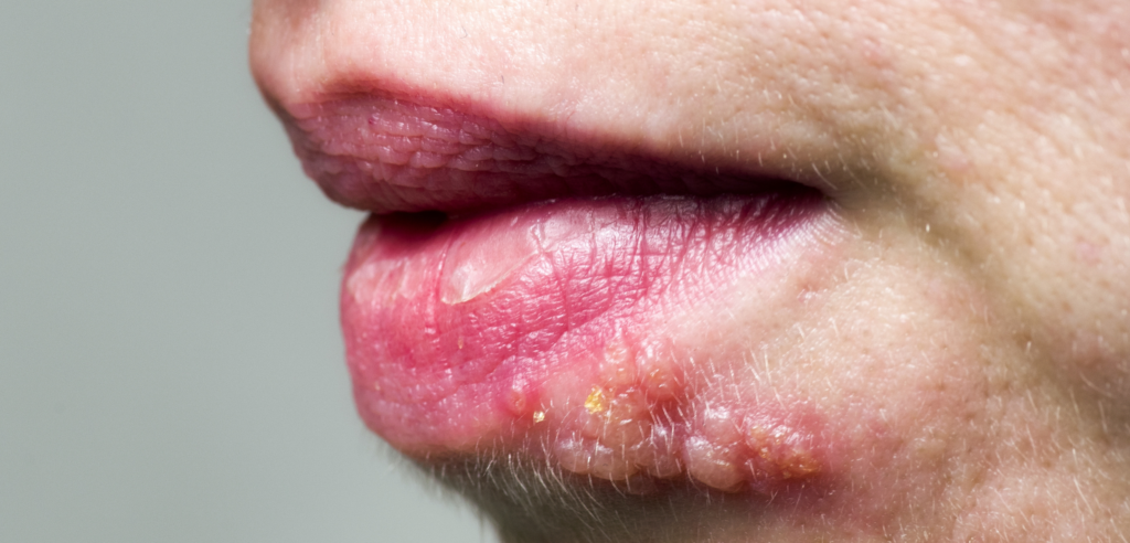 Herpes