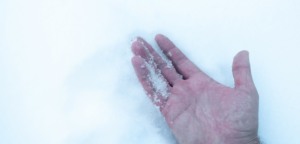 Frostbeulen: Hand im Schnee