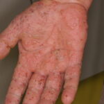 Hand mit Hautveränderungen