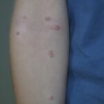 Arm mit Warzen