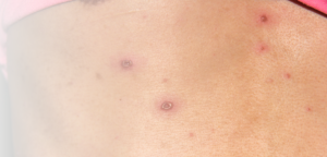 Haut mit Pocken