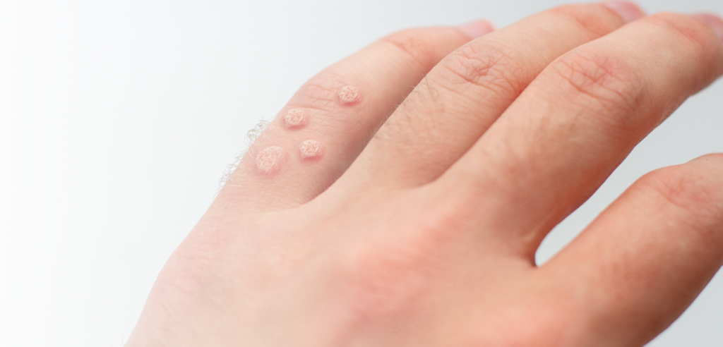 Hand mit vier kleinen Warzen auf dem kleinen Finger