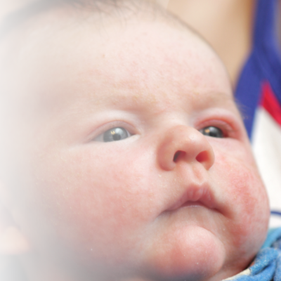 Gesicht eines Babys mit Neurodermitis