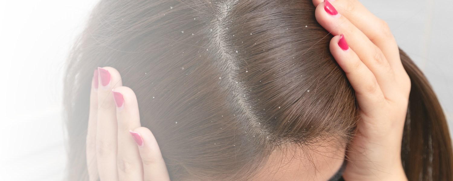 Frau mit dunklen Haaren betrachtet weiße Schuppen auf dem Kopf