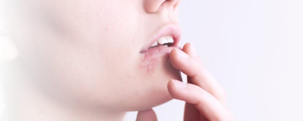 Finger berühren Lippen, die von Herpes / Bläschen betroffen sind.