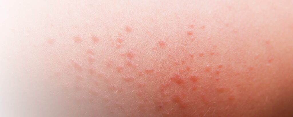 Hitzepickel: Haut mit vielen kleinen roten Pickeln