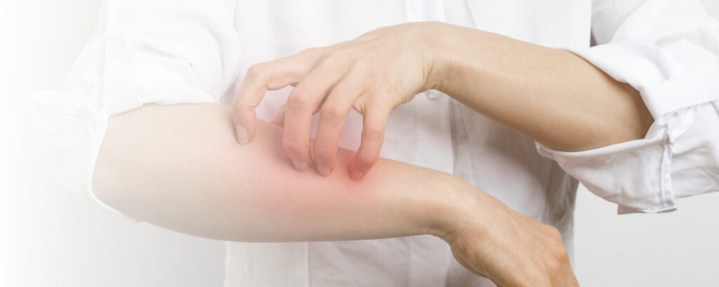 Person kratzt sich am Arm