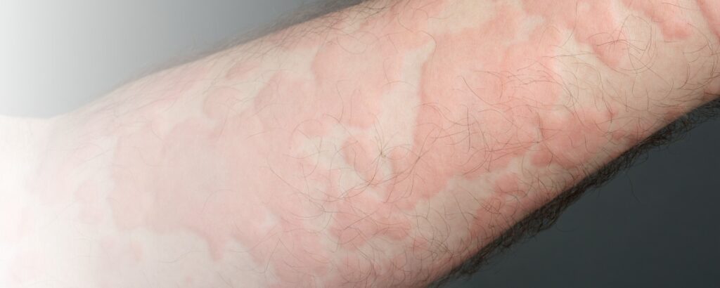Arm mit roten Quaddeln
