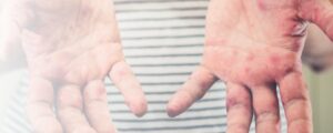Kinderhände mit Ekzem an den Händen
