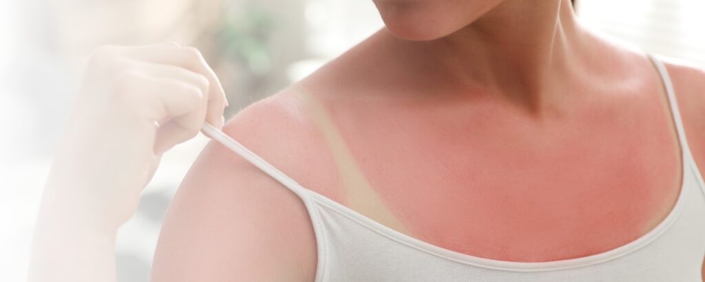 Sonnenbrand: Schulterbereich einer Frau, welcher bis auf einen Trägerabdruck stark gerötet ist