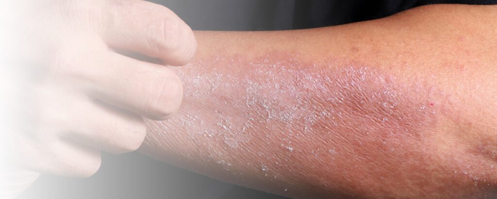 Arm mit trockener Haut