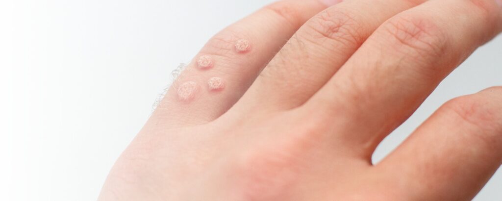 Hand mit vier kleinen Warzen auf dem kleinen Finger