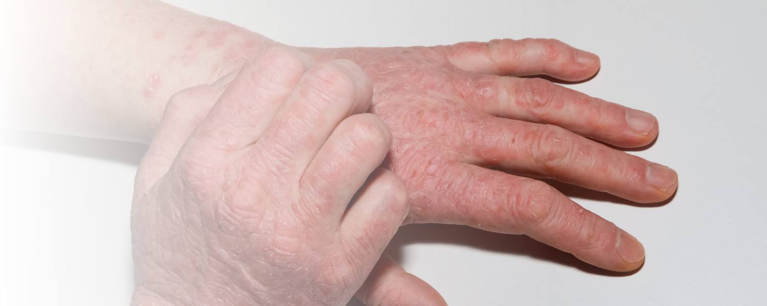 Berufsdermatosen: Hände mit rotem Ausschlag