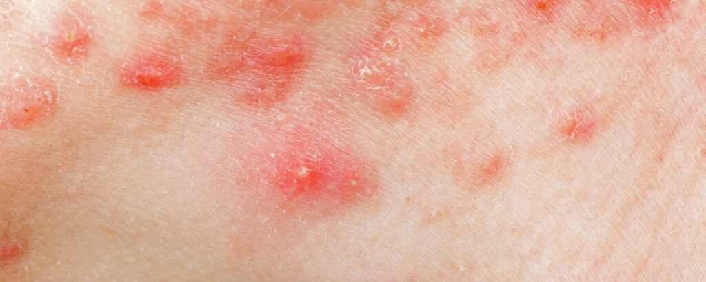 Akne inversa: Haut mit roten, eitrigen Pusteln