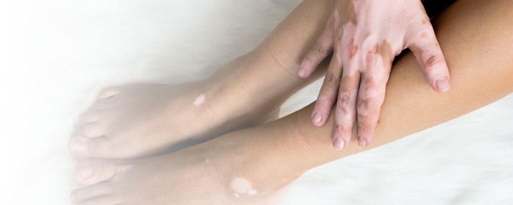 Weißfleckenkrankheit/ Vitiligo: Beine und Hand mit weißen Flecken