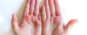 Hand mit Winterkekzemen