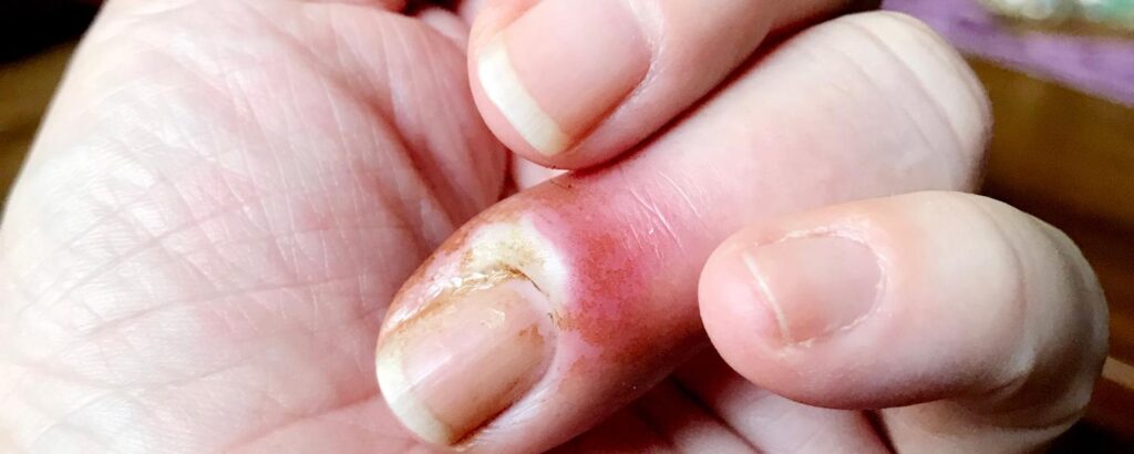 Nagelbettentzündung am Finger