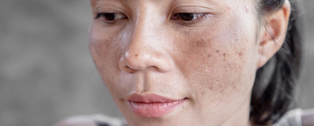 Frau mit Pigmentflecken im Gesicht