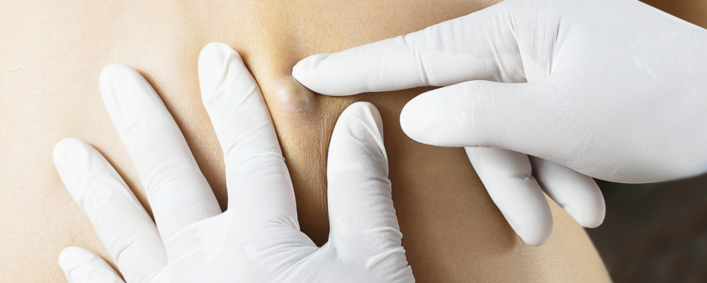Zwei Hände in weißen, medizinischen Handschuhen tasten einen Knoten / ein Atherom unter der Haut ab