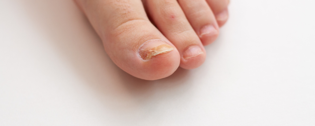 Fusspilz mit Nagelpilz am grossen Zeh