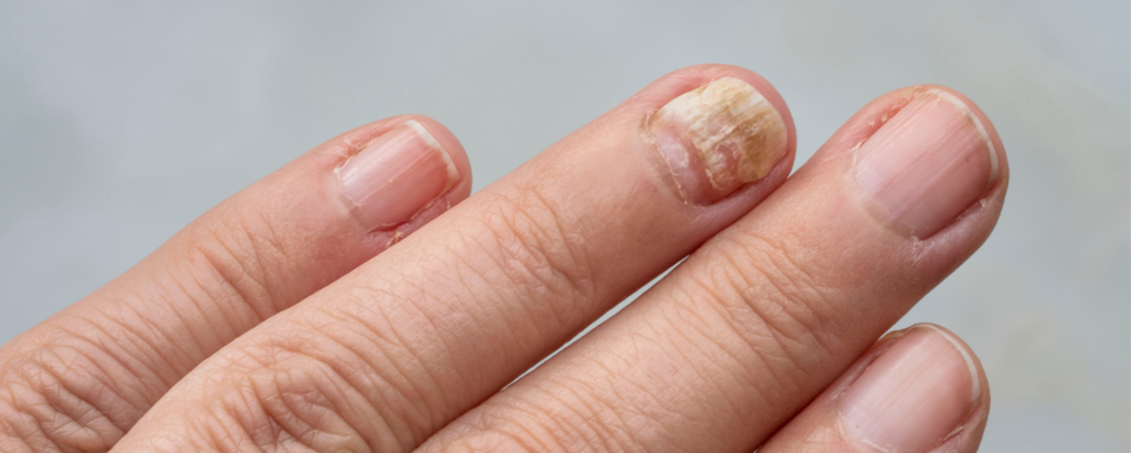 Nagelpilz am Fingernagel