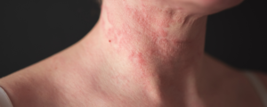 Hautausschlag / Dermatitis am Hals