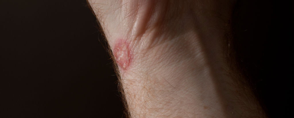 Kreisrunde Hautveränderung am Unterarm, Ringelflechte
