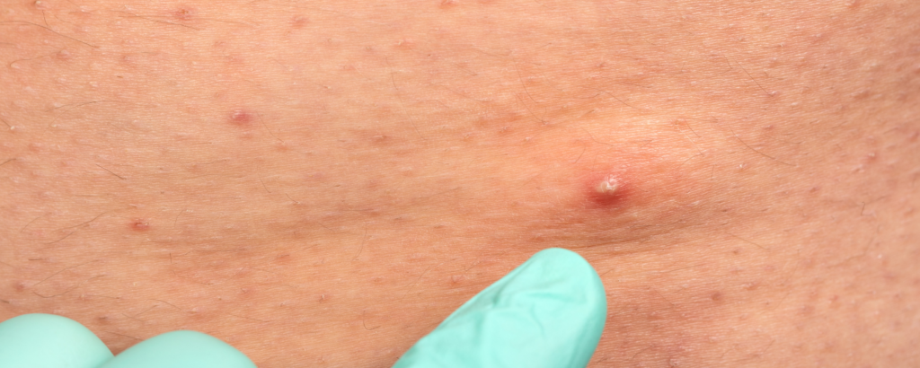 Finger in medizinischem Handschuh zeigt auf ein entzündetes Haarfollikel (Follikulitis)