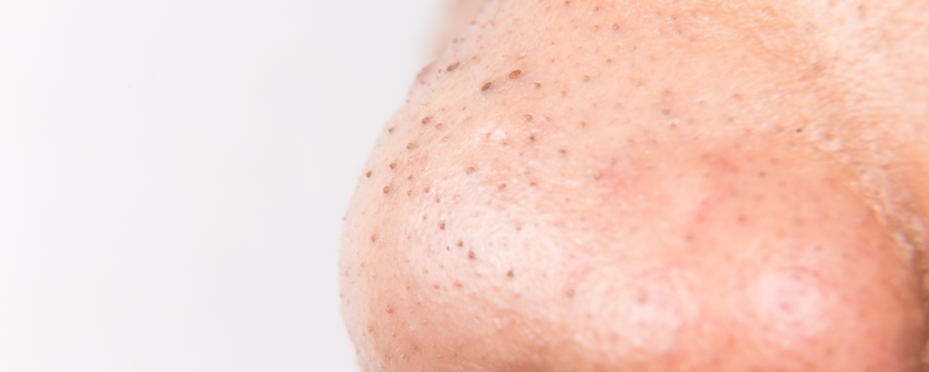 Schwarze Mitesser auf der Nase (Blackheads)