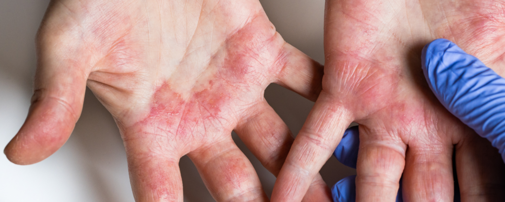 Untersuchung Kontaktdermatitis an den Handinnenflächen