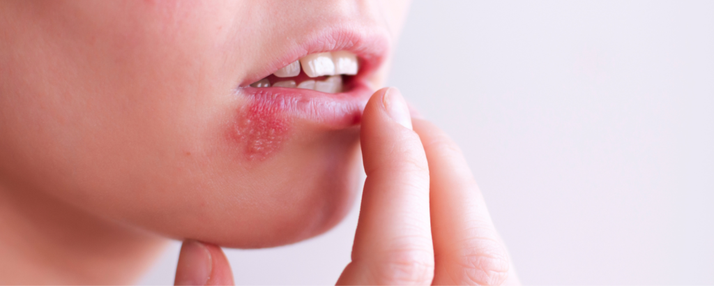 Herpes im Mundbereich