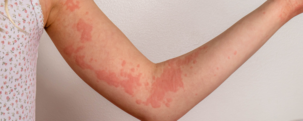 Nesselsucht am Arm