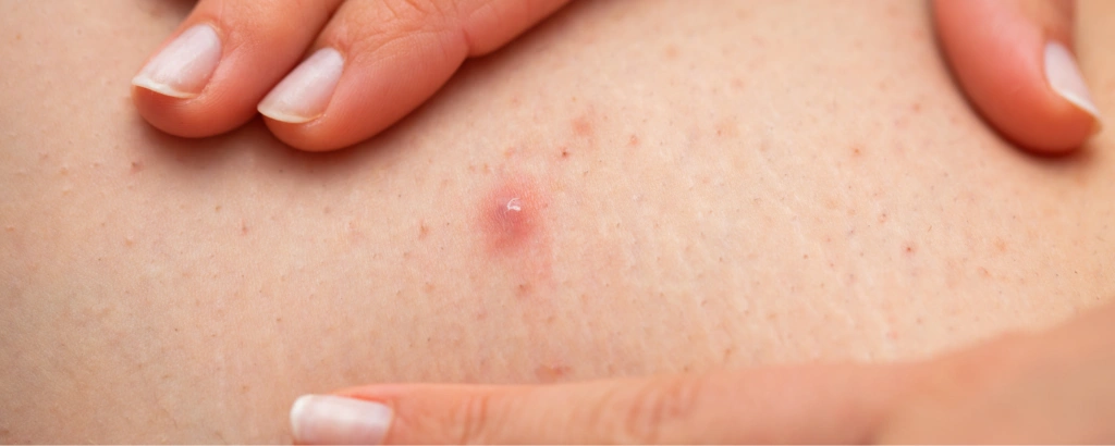 Follikulitis