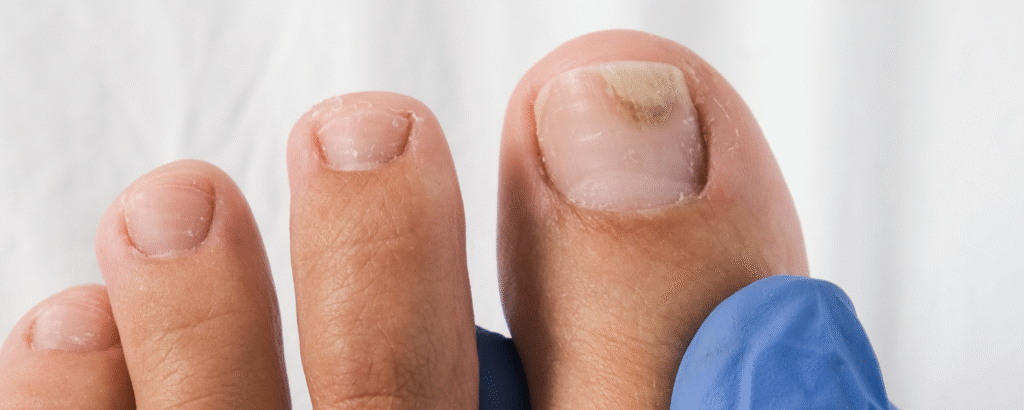 Onycholyse, Ablösung des Nagels am grossen Zeh, Nageldystrophie