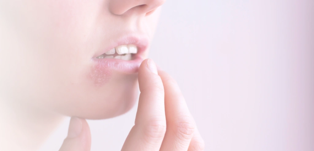 Herpes an der Lippe