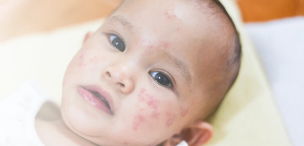 Baby mit Gürtelrose im Gesicht