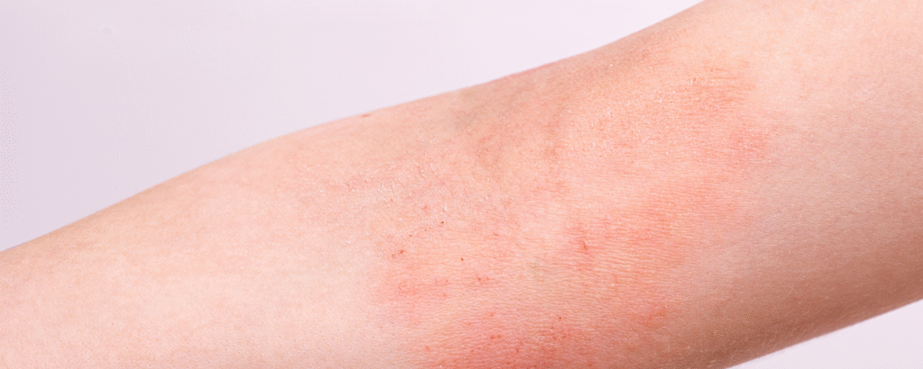 Lichenifikation am Arm